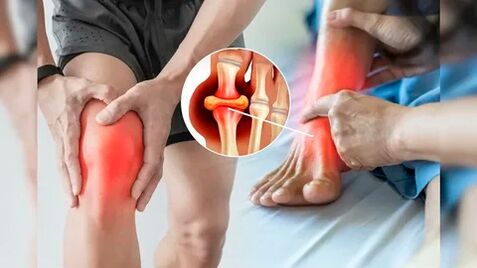 Oblasti pokožky vhodné na aplikáciu Icexin gélu (kolená, lakte, kríže)