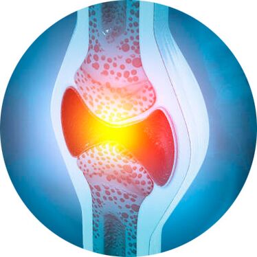 proces obnovy kĺbov pomocou gélu Icexin