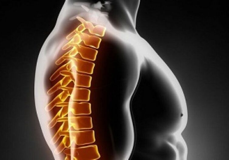 Hrudná osteochondróza sprevádza bolesť a nepohodlie v strede chrbta