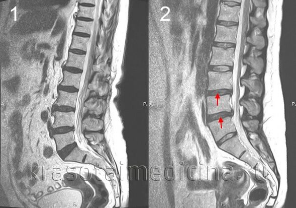 spinálna osteochondróza