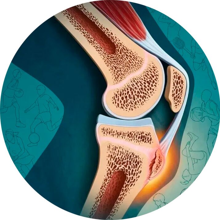 Štruktúra kĺbu a okolitých tkanív